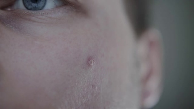 一个男人的脸颊上有一个红色的干丘疹，macro。皮肤问题，皮肤科