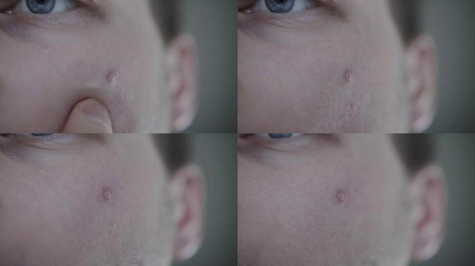 一个男人的脸颊上有一个红色的干丘疹，macro。皮肤问题，皮肤科
