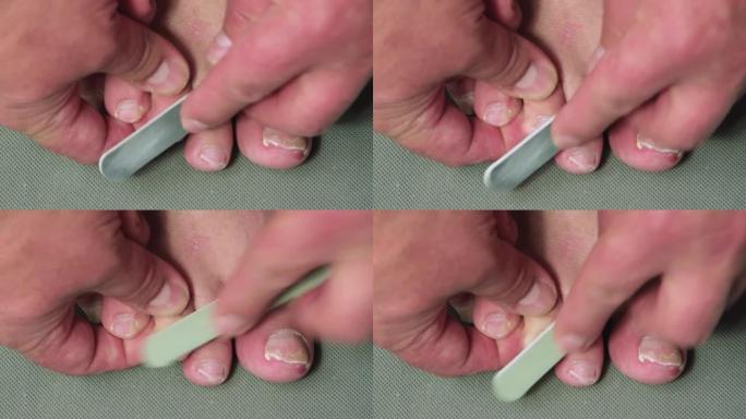 塑料指甲锉处理男性脚中脚趾的指甲。