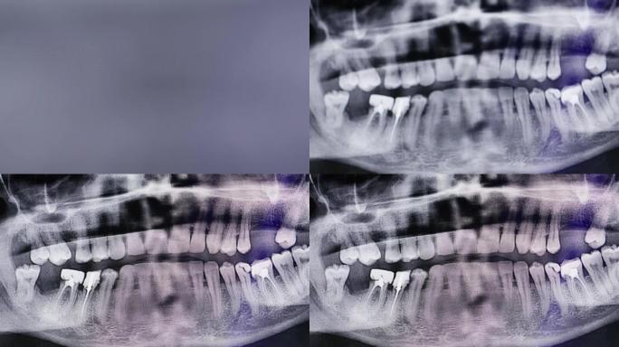 从模糊中出现了人类牙齿的x射线照片