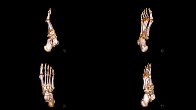 足部三维立体ct扫描诊断骨折。
