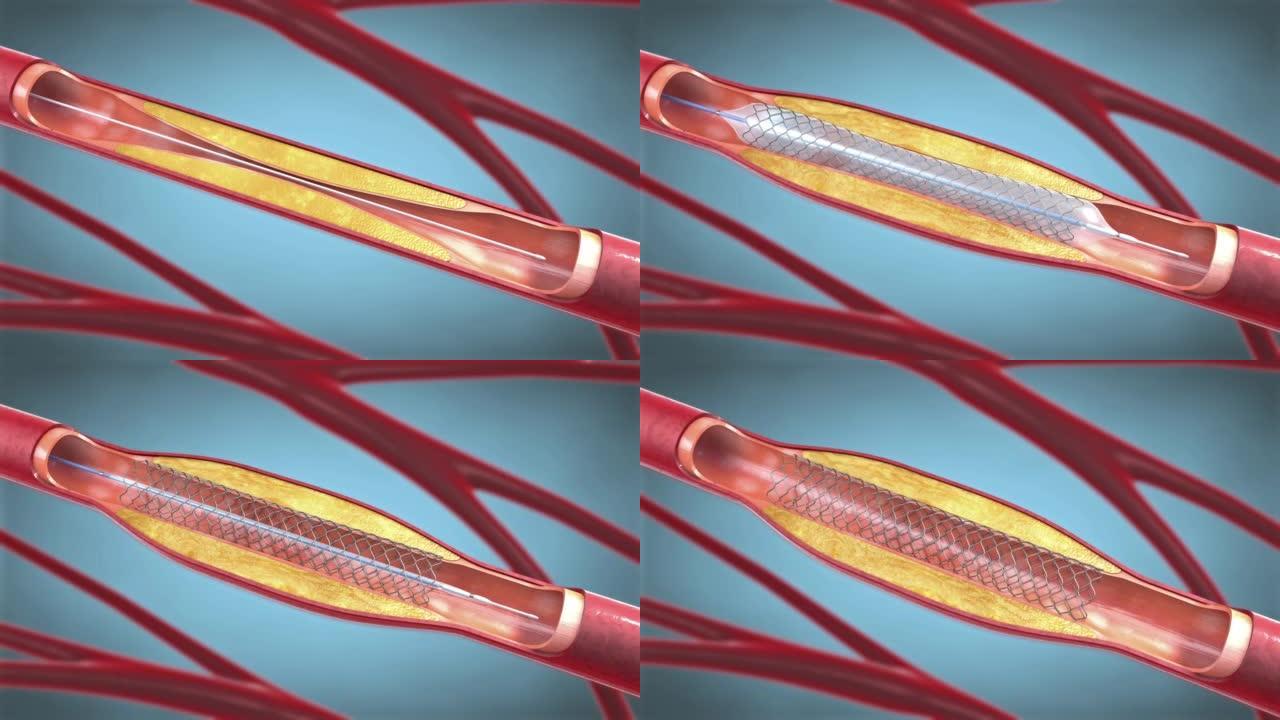 血管成形术中支持血液循环进入血管的支架植入-3d插图