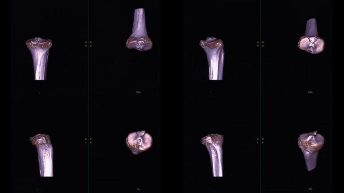 膝关节三维渲染的ct扫描。