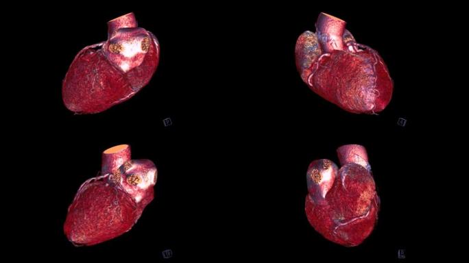 CTA冠状动脉三维渲染。
