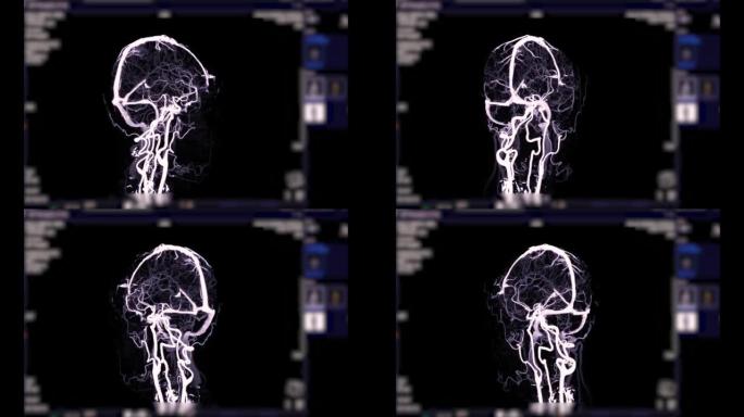 CTV脑部扫描3D渲染诊断静脉窦血栓形成。