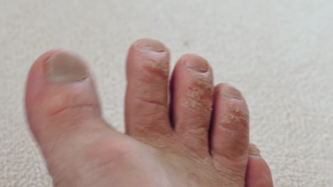 患有真菌脚趾，真菌足部疾病的人的脚的特写镜头，