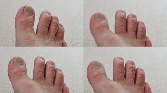 患有真菌脚趾，真菌足部疾病的人的脚的特写镜头，
