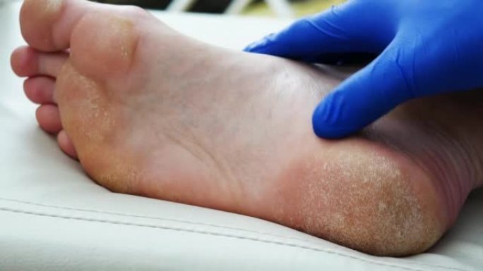 皮肤干燥，脚的牛皮癣皮肤受损。皮炎，湿疹，银屑病，过敏反应。一个人脱皮和脚裂开的特写。真菌感染或脚癣