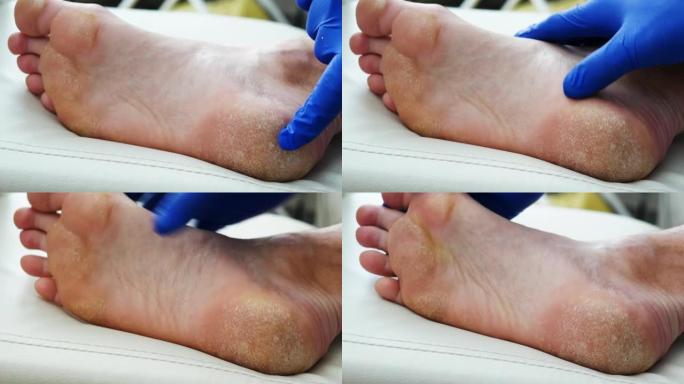 皮肤干燥，脚的牛皮癣皮肤受损。皮炎，湿疹，银屑病，过敏反应。一个人脱皮和脚裂开的特写。真菌感染或脚癣