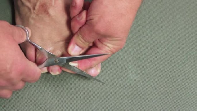 大型金属剪刀剪断了男人脚尖上的钉子。