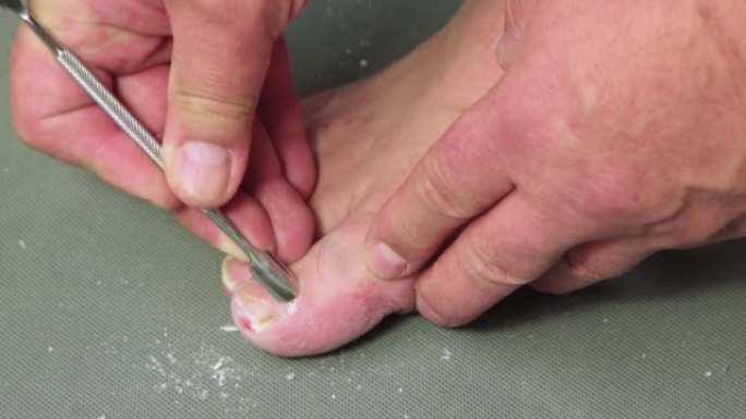 金属刮刀刷男性大脚趾上的角质层。