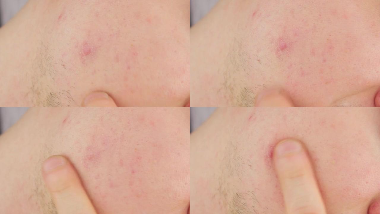 一个男人脸上的粉刺。脸上的皮肤上有痤疮。脸上的红点。