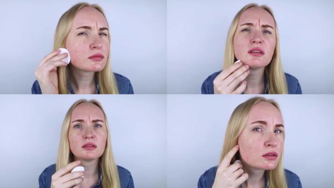 对化妆品过敏。女孩从劣质的乳霜，粉粉或粉底中得到粉刺。皮肤对不合格或有毒产品反应的概念。