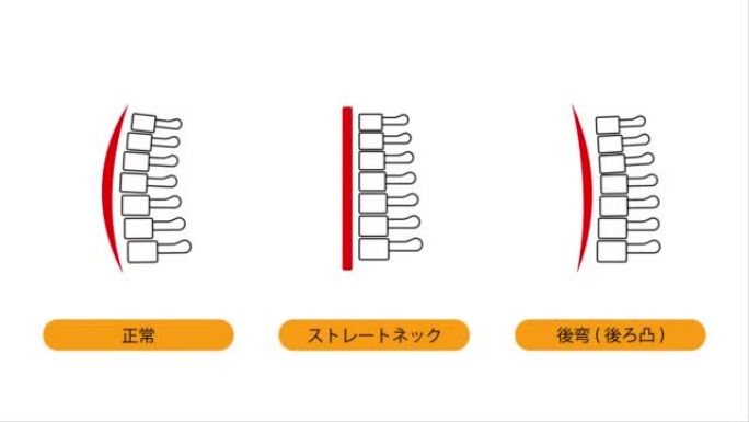 这是一个动画视频，显示了直颈，颈椎后凸和正常颈骨的图像。