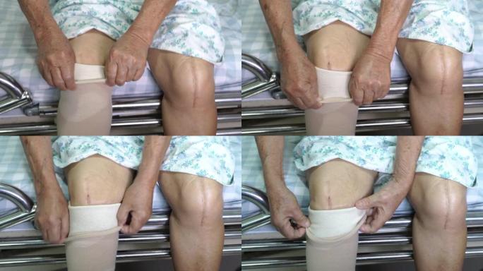 亚洲老年或老年老太太患者在护理医院病房显示她的疤痕手术全膝关节置换缝合伤口手术关节置换术，健康医学观