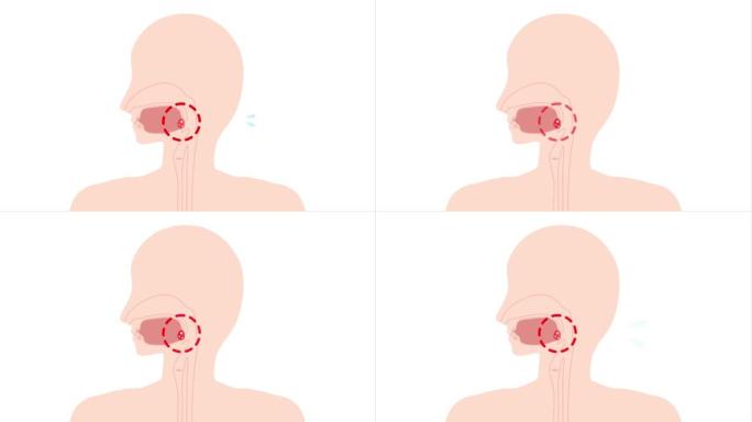 这是一个扁桃体炎炎症的动画视频。可循环