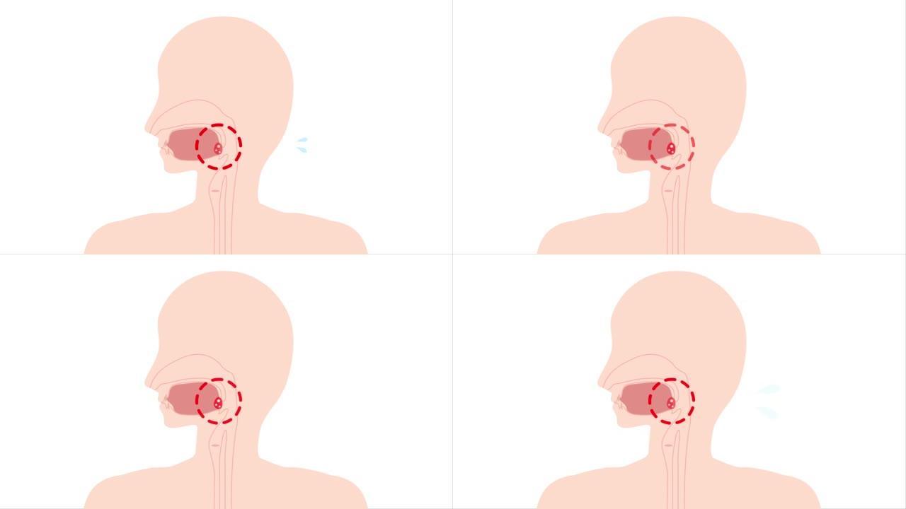 这是一个扁桃体炎炎症的动画视频。可循环