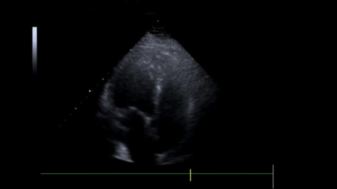 视频超声心动图或心脏超声