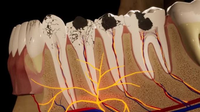 龋齿损坏的臼齿。医学上精确的牙齿3D动画