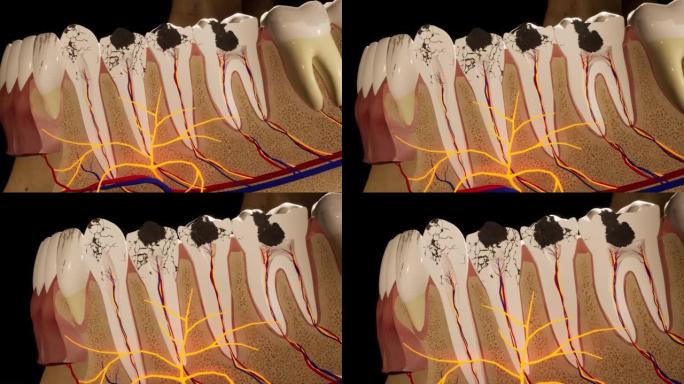 龋齿损坏的臼齿。医学上精确的牙齿3D动画