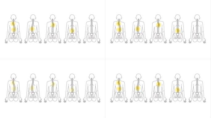 这是一个关于各种脊柱侧弯和疼痛的动画视频。Loopable