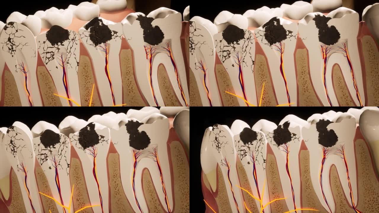 龋齿损坏的臼齿。医学上精确的牙齿3D动画