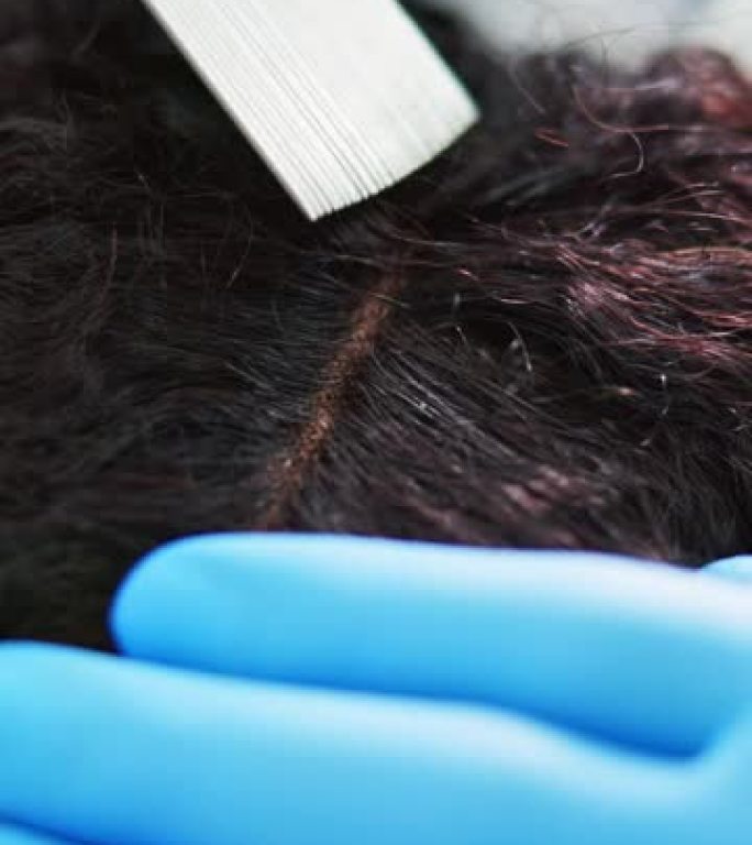 牛皮癣和头皮屑的头皮治疗