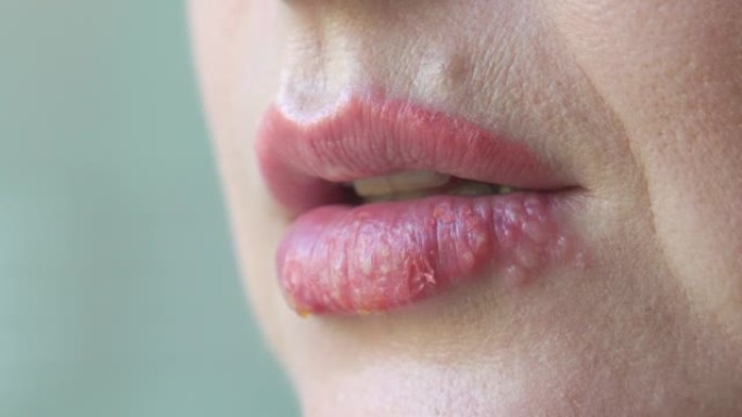 受疱疹疾病影响的女性嘴唇。特写。