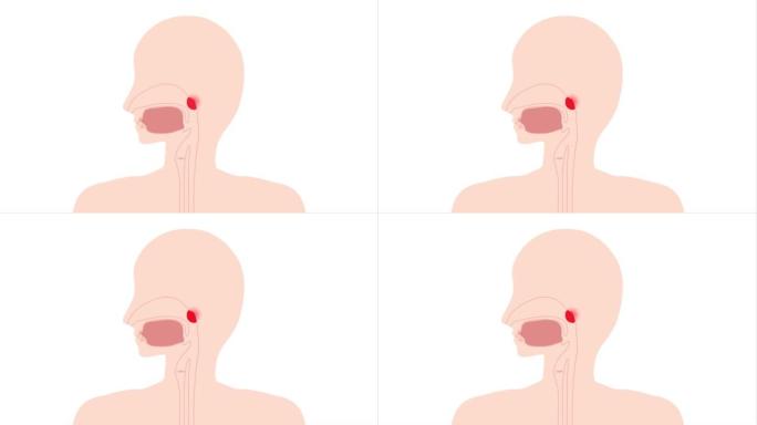 这是腺样体肥大炎症的动画视频。可循环