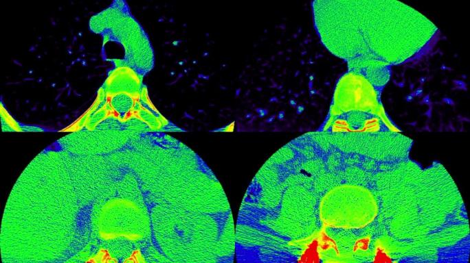 腰椎ct扫描颜色。