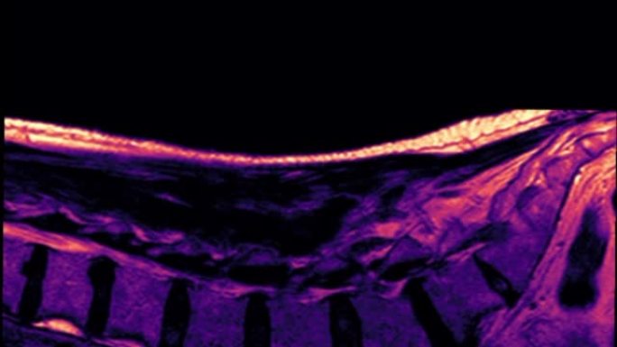 腰椎MR扫描颜色。
