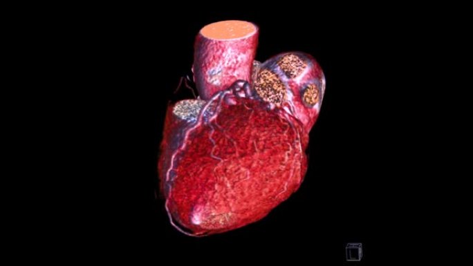 CTA冠状动脉三维渲染。