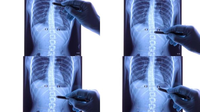 医生分析脊柱x线片显示腰椎区脊柱侧弯