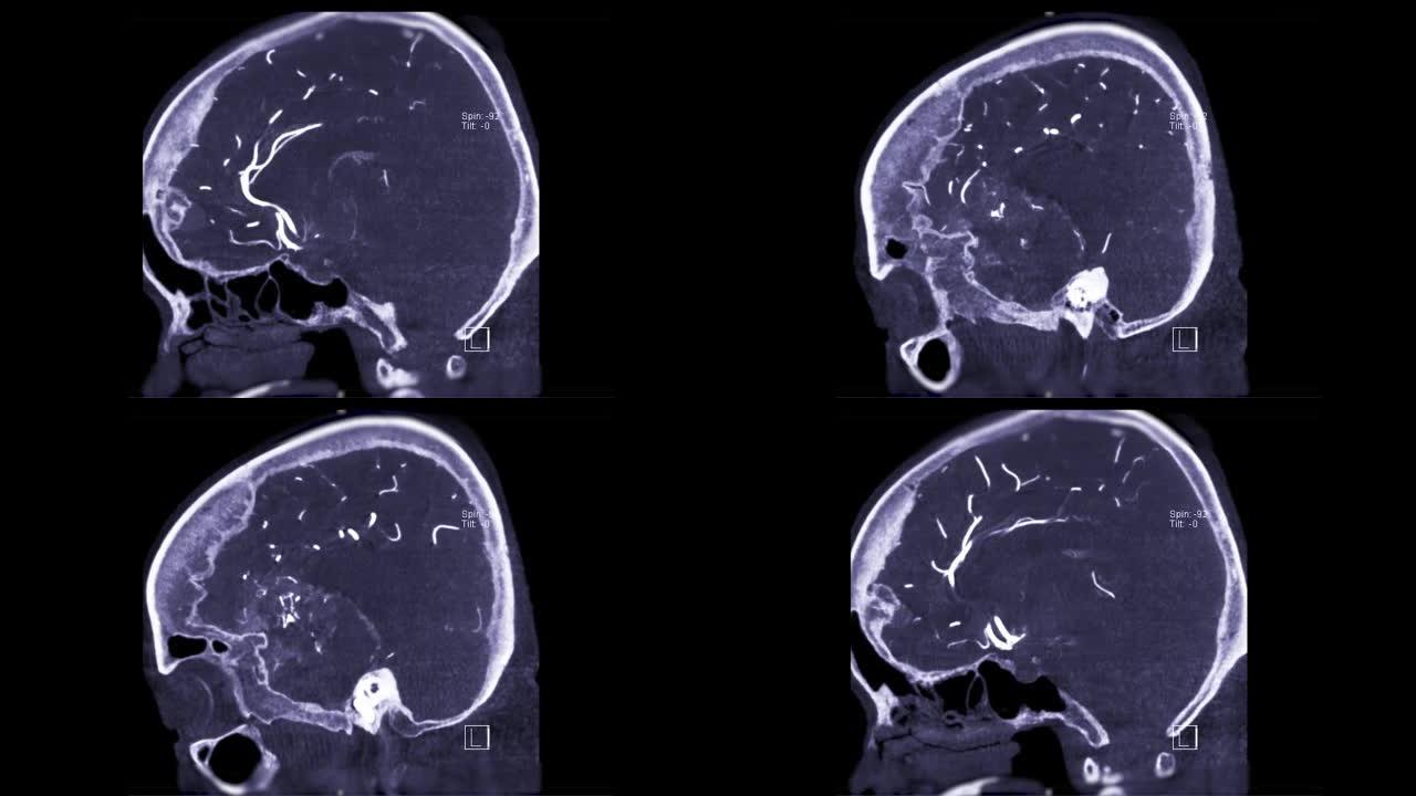 脑血管造影术。