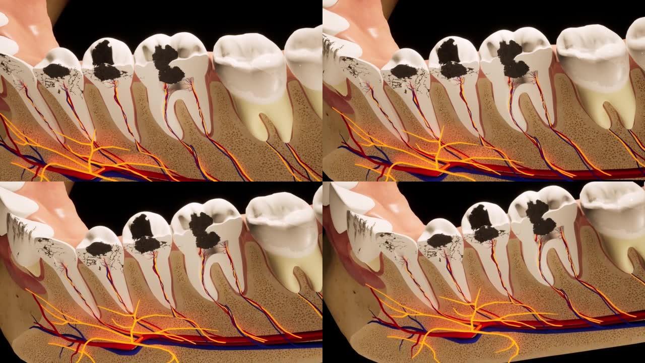 龋齿损坏的臼齿。医学上精确的牙齿3D动画