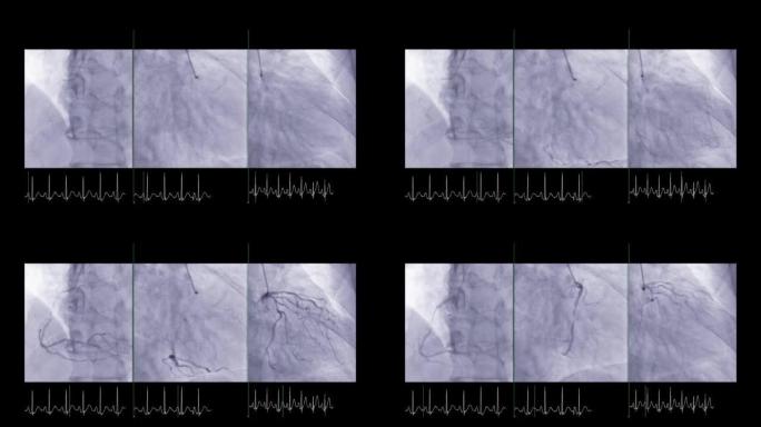 显示冠状动脉的心导管检查以诊断心脏骤停。
