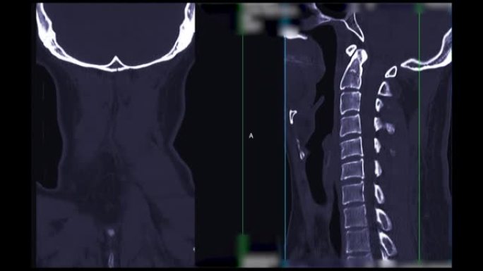颈椎ct扫描