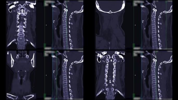 颈椎ct扫描