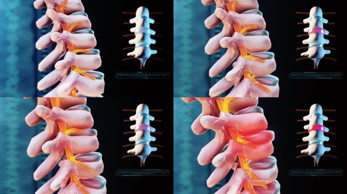 椎间盘突出脊椎脊柱突出
