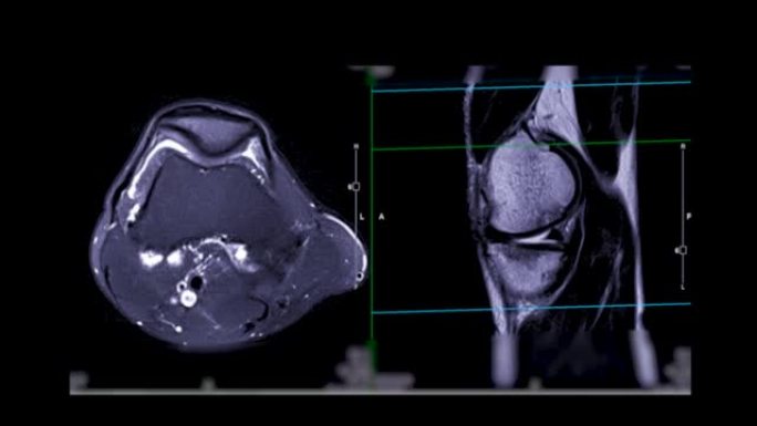 MRI膝关节或膝关节的磁共振成像。