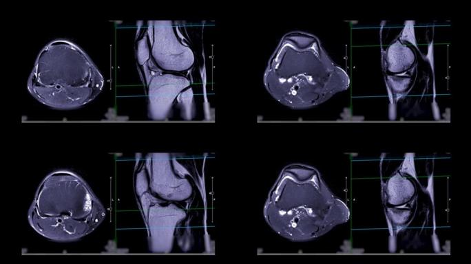 MRI膝关节或膝关节的磁共振成像。