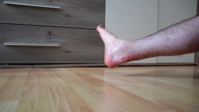 欧洲男子在跟腱断裂手术后通过手动治疗和康复锻炼伸展跟腱，尽管疼痛的疤痕疼痛，以恢复脚跟脚踝和腿部的力