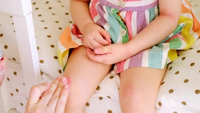 婴儿膝盖上的红色粗糙伤口。妈妈将乳霜从管到患有特应性皮炎的儿童的疾病，疾病皮肤。缓解过敏性疾病症状的