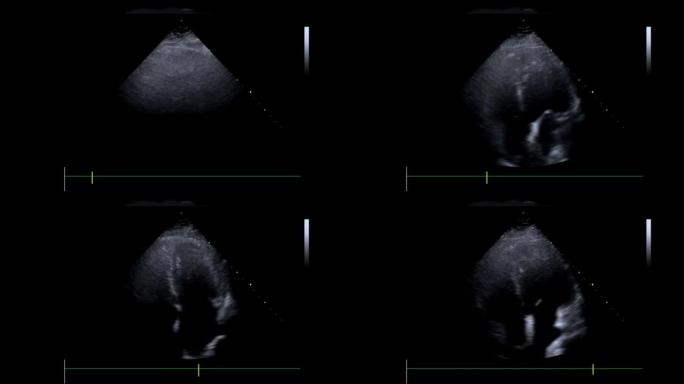 带有心脏监护仪检查的超声仪