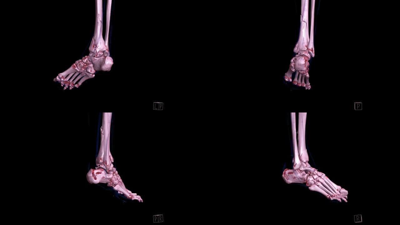 足部三维立体ct扫描诊断骨折。