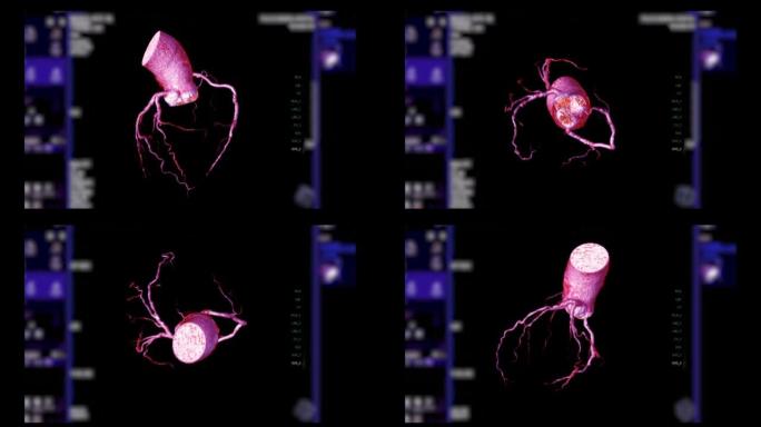 CTA冠状动脉三维渲染。