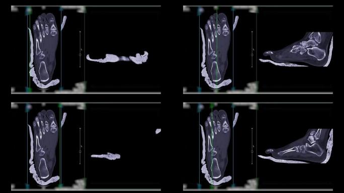 足部ct扫描诊断骨折。