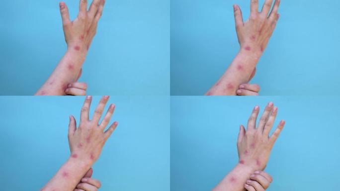 女人用皮疹抓伤双手，红斑水泡。猴痘在世界范围内是危险的新疾病。猴痘患者。特写皮疹，人类有健康问题。复