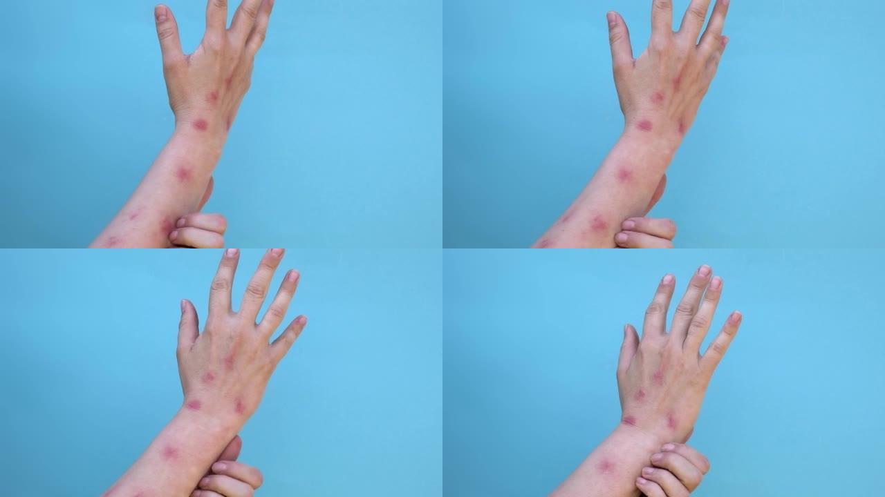 女人用皮疹抓伤双手，红斑水泡。猴痘在世界范围内是危险的新疾病。猴痘患者。特写皮疹，人类有健康问题。复