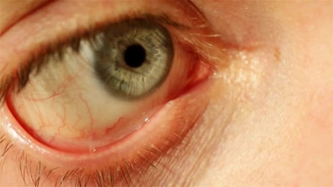 病后关闭的人的眼睛有细的红色毛细血管